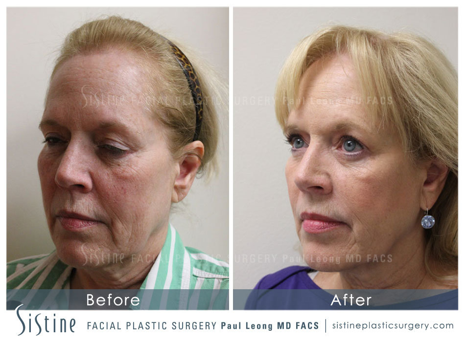 Phoenix Co2 Before and After | Leong Facial Plastic Surgery