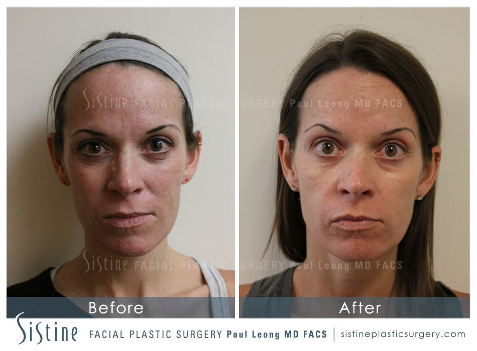 Phoenix Co2 Before and After | Leong Facial Plastic Surgery