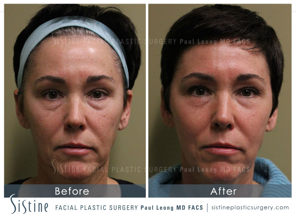 Phoenix Co2 Before and After | Leong Facial Plastic Surgery