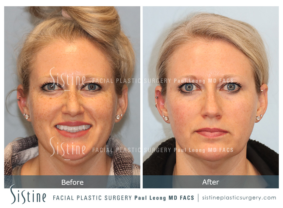 Photofacial Before and After | Leong Facial Plastic Surgery