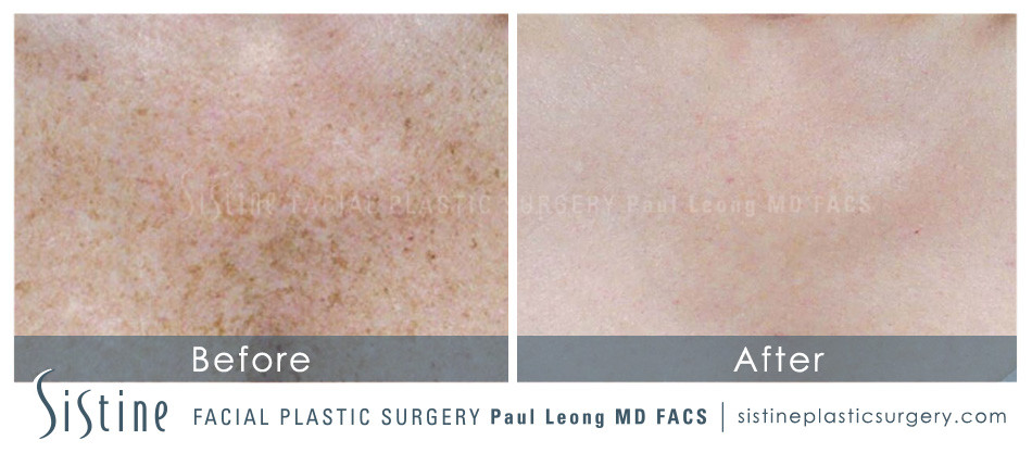 Photofacial Before and After | Leong Facial Plastic Surgery