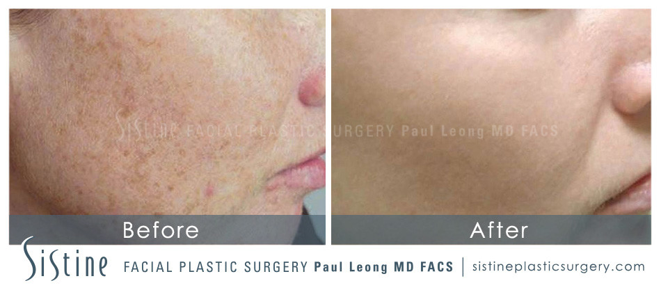 Photofacial Before and After | Leong Facial Plastic Surgery