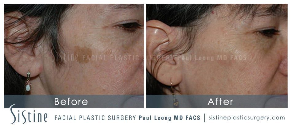 Photofacial Before and After | Leong Facial Plastic Surgery