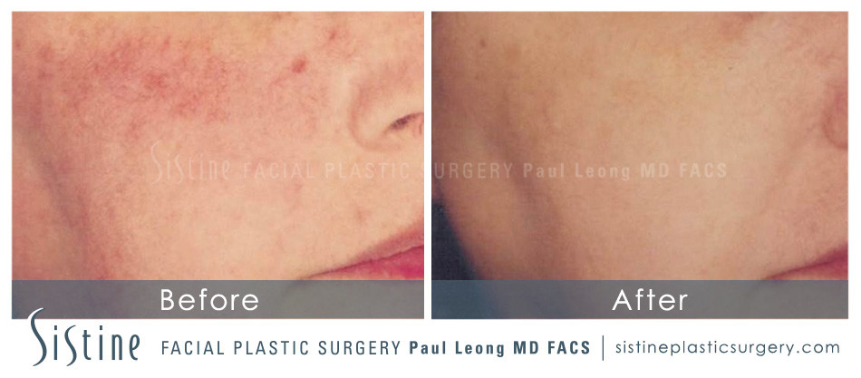 Photofacial Before and After | Leong Facial Plastic Surgery