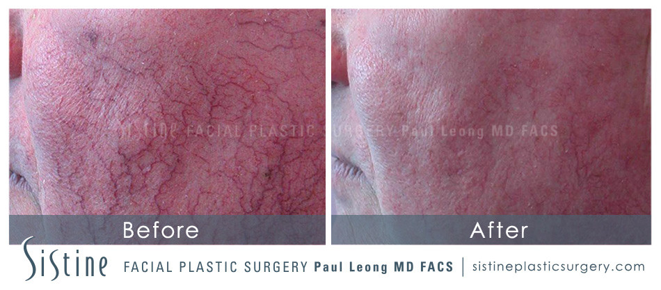 Photofacial Before and After | Leong Facial Plastic Surgery