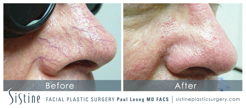 Photofacial Before and After | Leong Facial Plastic Surgery