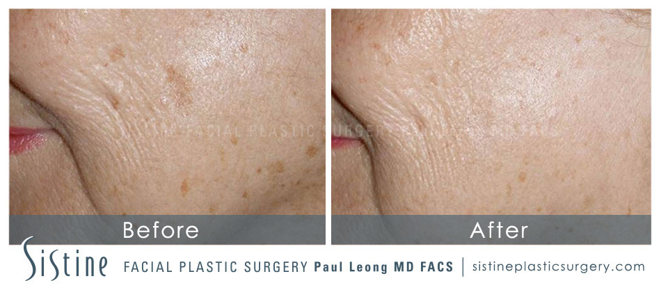 Photofacial Before and After | Leong Facial Plastic Surgery