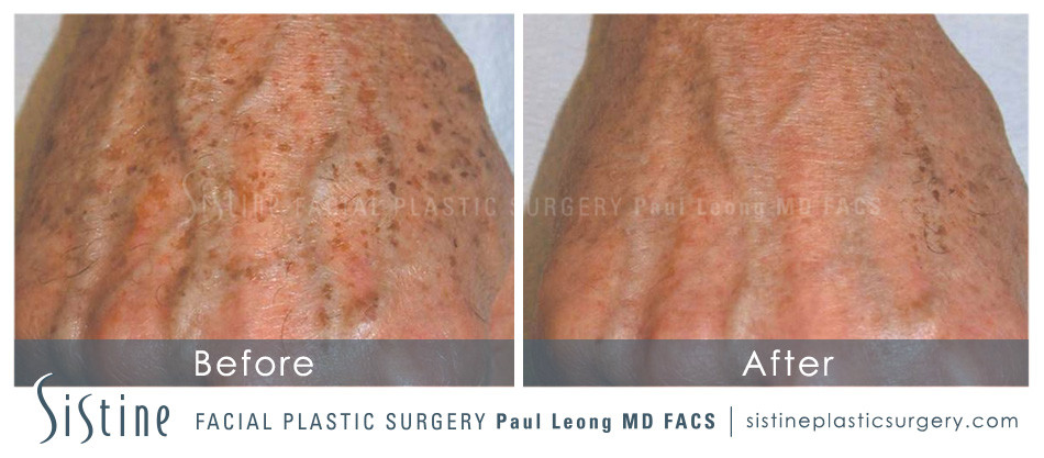 Photofacial Before and After | Leong Facial Plastic Surgery