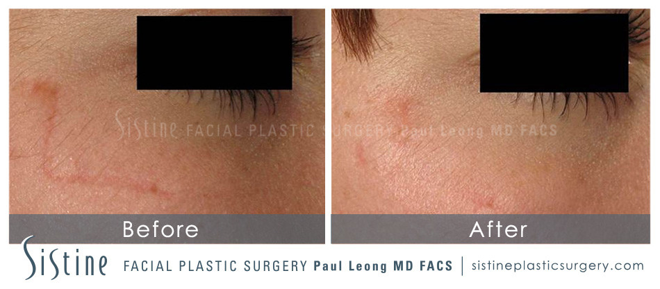 Scar Wrinkle Removal Before and After | Leong Facial Plastic Surgery