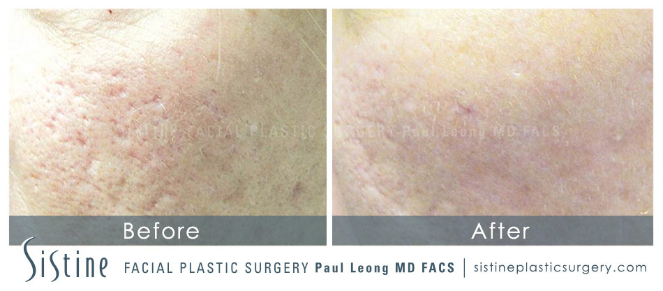 Scar Wrinkle Removal Before and After | Leong Facial Plastic Surgery