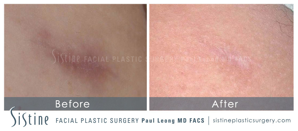 Scar Wrinkle Removal Before and After | Leong Facial Plastic Surgery