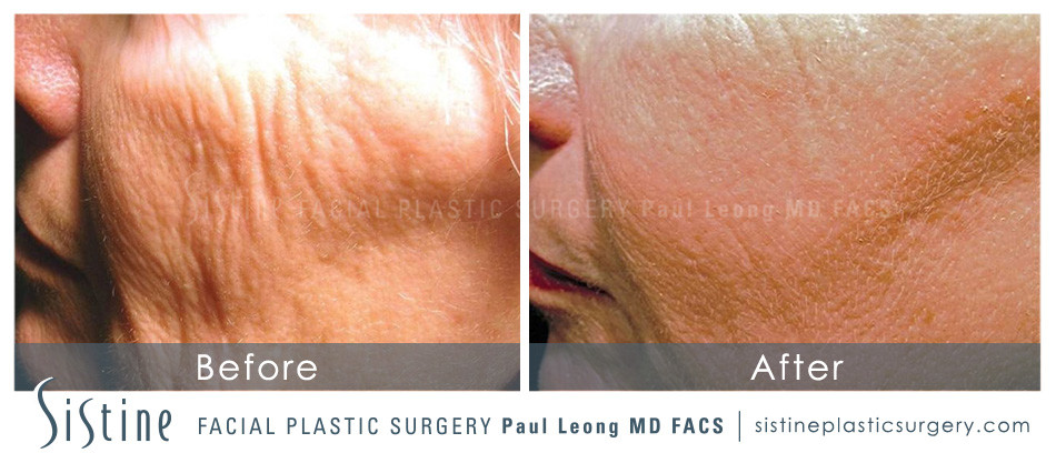 Scar Wrinkle Removal Before and After | Leong Facial Plastic Surgery