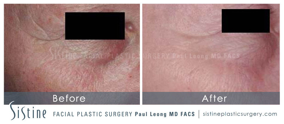 Scar Wrinkle Removal Before and After | Leong Facial Plastic Surgery