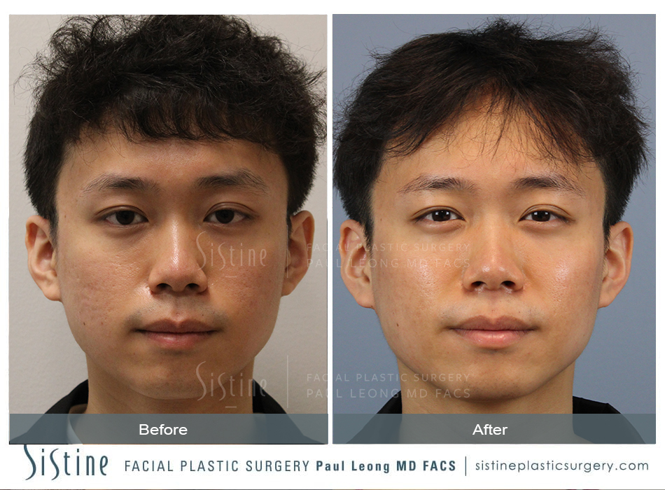 Skinpen Microneedling Before and After | Leong Facial Plastic Surgery