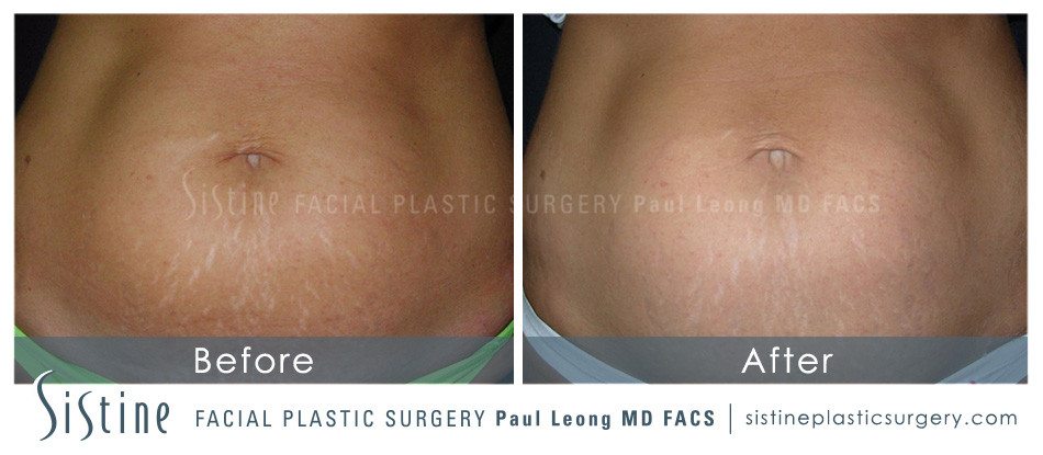 Stretch Marks Before and After | Leong Facial Plastic Surgery