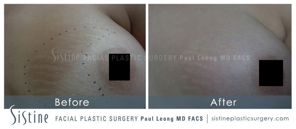 Stretch Marks Before and After | Leong Facial Plastic Surgery