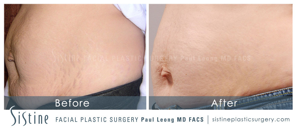 Stretch Marks Before and After | Leong Facial Plastic Surgery