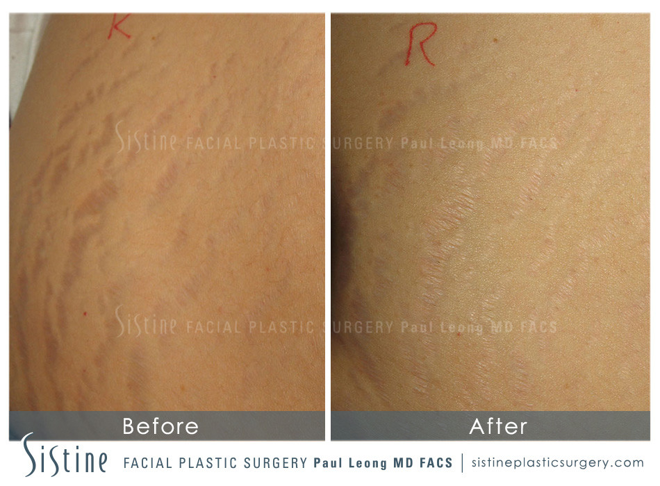 Stretch Marks Before and After | Leong Facial Plastic Surgery