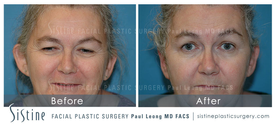 Ears Before and After | Leong Facial Plastic Surgery