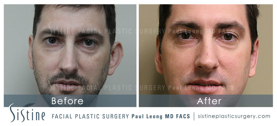 Ears Before and After | Leong Facial Plastic Surgery