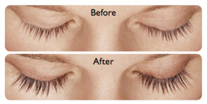 Latisse Eyelash Growth Pittsburgh