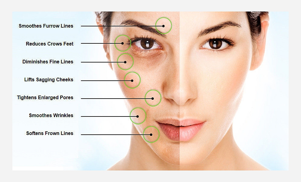 SkinPen Microneedling Treatments Pittsburgh